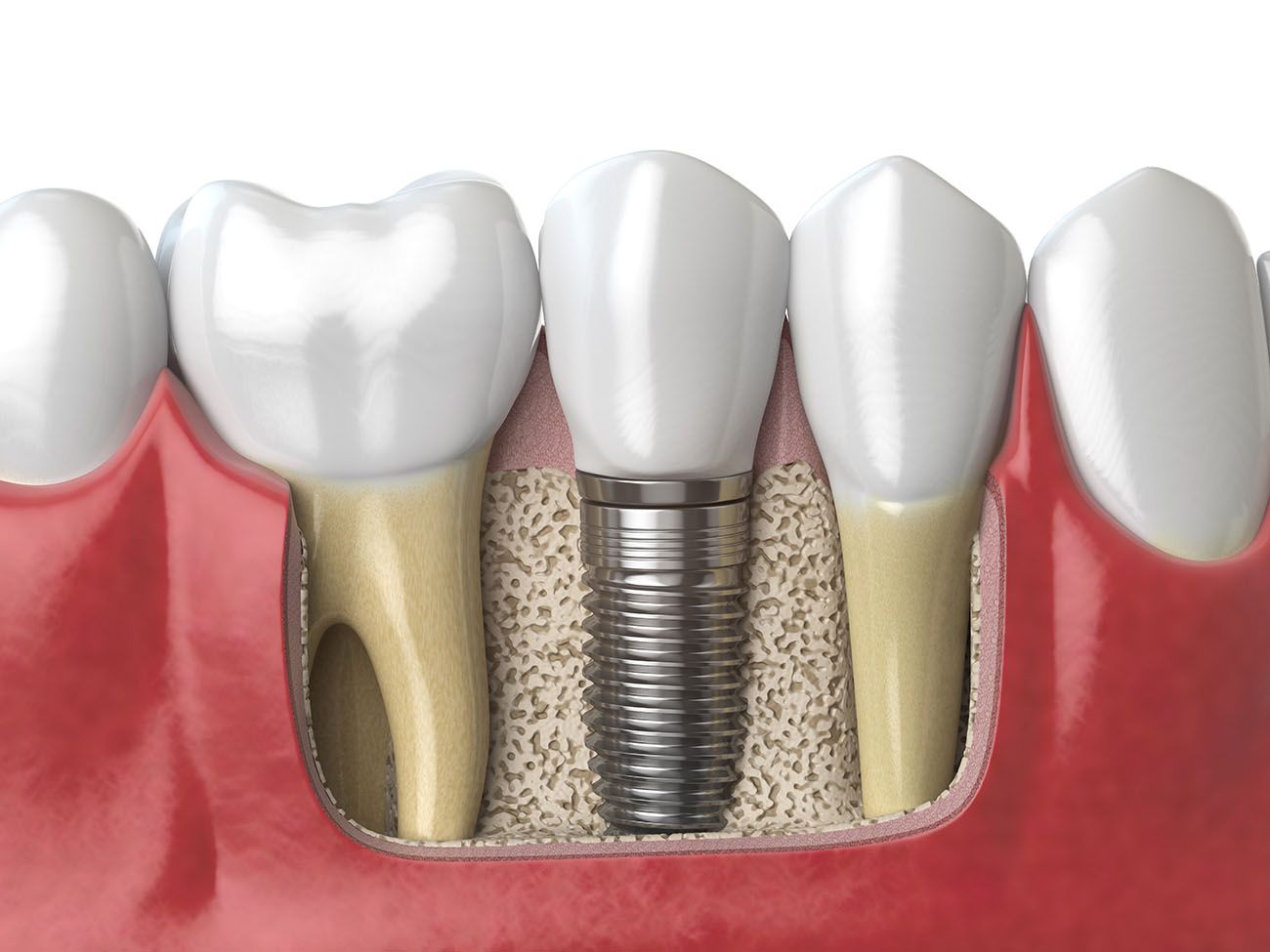 Why Should I Replace Missing Teeth With Dental Implants Dentistry At