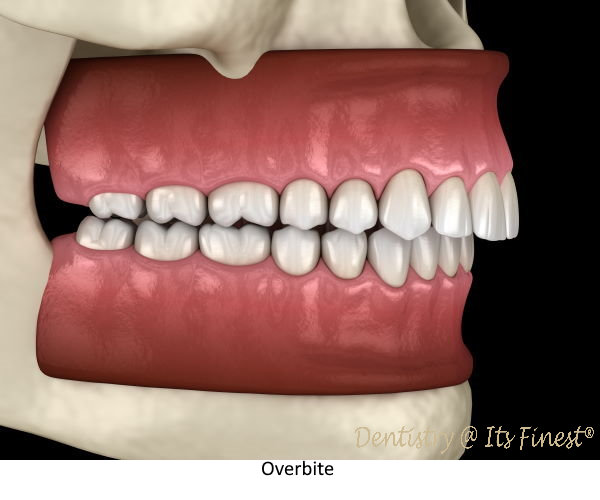 Overbite: Causes, Risks and Treatment — WoodSprings Dentistry