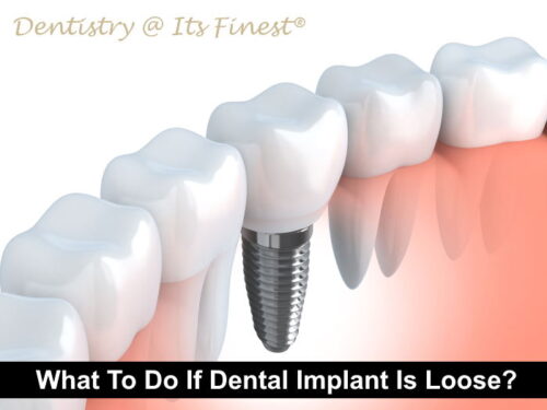 What To Do If Dental Implant Is Loose? - Dentistry At Its Finest