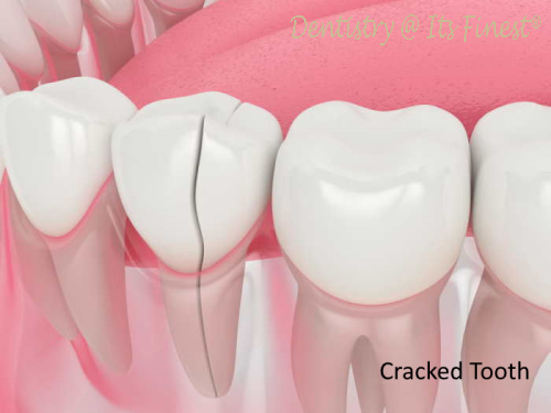 Illustration Of Cracked Tooth Repair Smile Mouth With Cracked