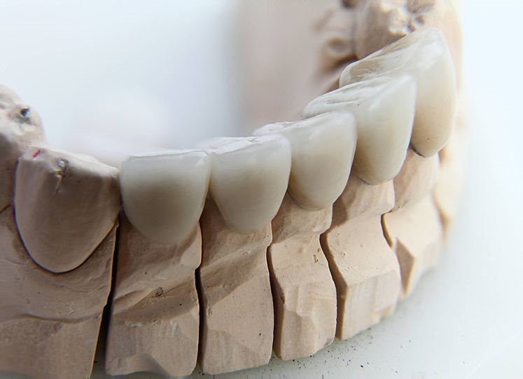 Cost Tooth Crown 