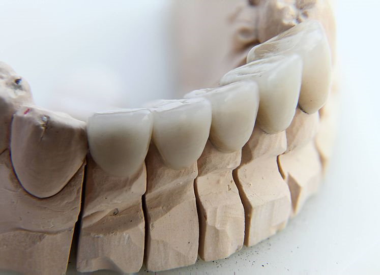 Dental Crown Cost How Much Is A Tooth Crown Porcelain 2023 Laacib